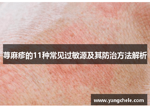 荨麻疹的11种常见过敏源及其防治方法解析
